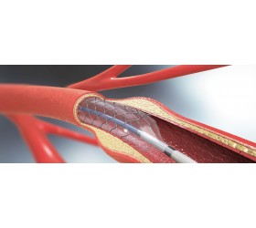 Kit para Angioplastia com conector em Y com válvula hemostática, introdutor