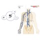 Catéter Venoso Totalmente Implantável Micro polysite