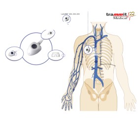 Catéter Venoso Totalmente Implantável Micro polysite