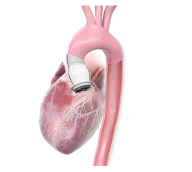 Valvula mecanica aortica ON -X