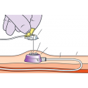 Cateter Totalmente Implantável para Quimioterapia Cateter Totalmente Implantável para Quimioterapia